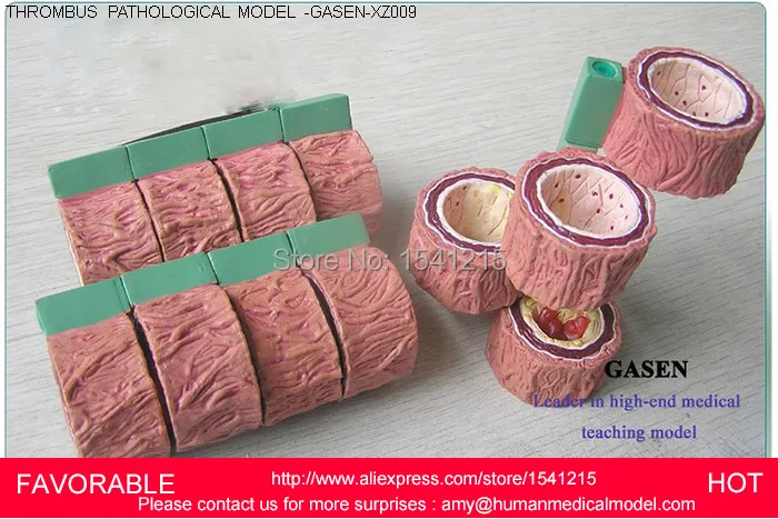 ATHEROSCLEROSIS WITH VASCULAR THROMBOSIS PROCESS MODEL THROMBOSIS MODEL VASCULAR MODEL,THROMBOSIS ANATOMY MODEL-GASEN-XZ009
ATHEROSCLEROSIS WITH VASCULAR THROMBOSIS PROCESS MODEL THROMBOSIS MODEL VASCULAR MODEL,THROMBOSIS ANATOMY MODEL-GASEN-XZ009