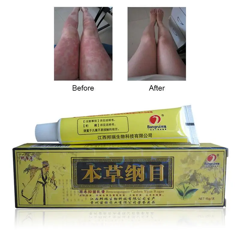 psoriasis eczema herbal cream