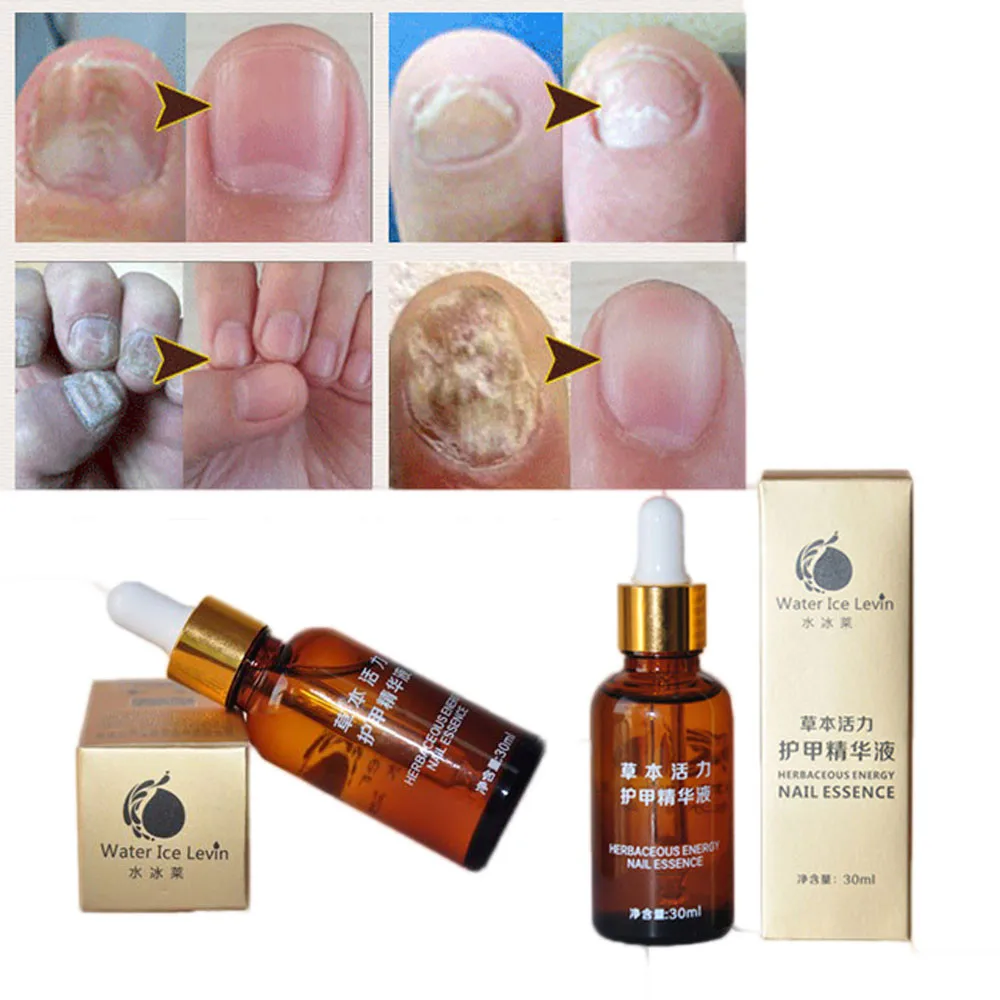 Herbal Natural Ingredients Nail Treatment Essence Nail And Foot Whitening Toe Nail Fungus Removal Manicure Tools Care Nail Art
Herbal Natural Ingredients Nail Treatment Essence Nail And Foot Whitening Toe Nail Fungus Removal Manicure Tools Care Nail Art