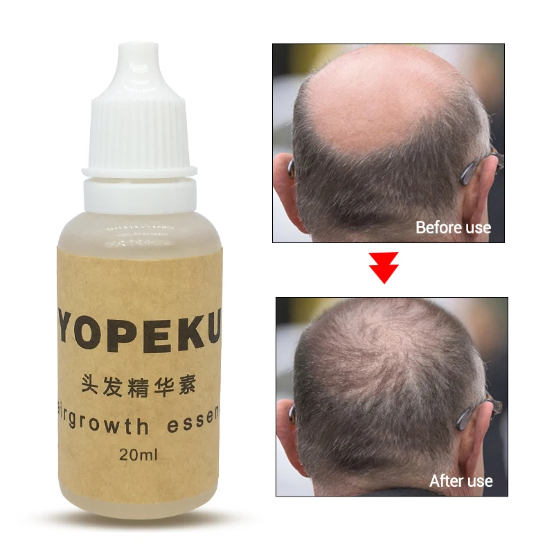 YOPEKU 20ml Fast Powerful Hair Growth Essence Hair Loss Products Essential Oil Liquid Treatment Preventing Hair Care Products
YOPEKU 20ml Fast Powerful Hair Growth Essence Hair Loss Products Essential Oil Liquid Treatment Preventing Hair Care Products