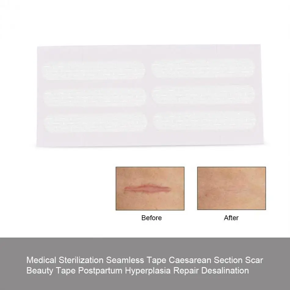 Medical Silicone Scar Sheet Sterilization Seamless Tape Caesarean Section Scar Tissue Beauty Tape Fade & Repair Unsightly Scar
Medical Silicone Scar Sheet Sterilization Seamless Tape Caesarean Section Scar Tissue Beauty Tape Fade & Repair Unsightly Scar