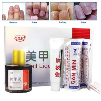 Toe Nail Fungus Treatment Of Chinese Medicine Herbs Anti Fungal Infection Essence Nail Treatment Removal Nail Care Lotion
Toe Nail Fungus Treatment Of Chinese Medicine Herbs Anti Fungal Infection Essence Nail Treatment Removal Nail Care Lotion