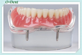 Dental implant model Teeth Study Model Overdenture Inferior 2 Implant Demo
Dental implant model Teeth Study Model Overdenture Inferior 2 Implant Demo