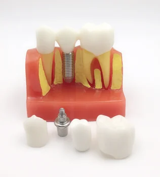 4X implant dental model oral teeth model dental teaching demonstration model
4X implant dental model oral teeth model dental teaching demonstration model