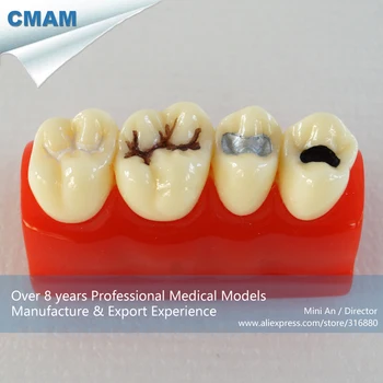 DH/13154, Tooth Caries Anatomy, Sealantant Demonstration, Educational Teaching Anatomical Models
DH/13154, Tooth Caries Anatomy, Sealantant Demonstration, Educational Teaching Anatomical Models