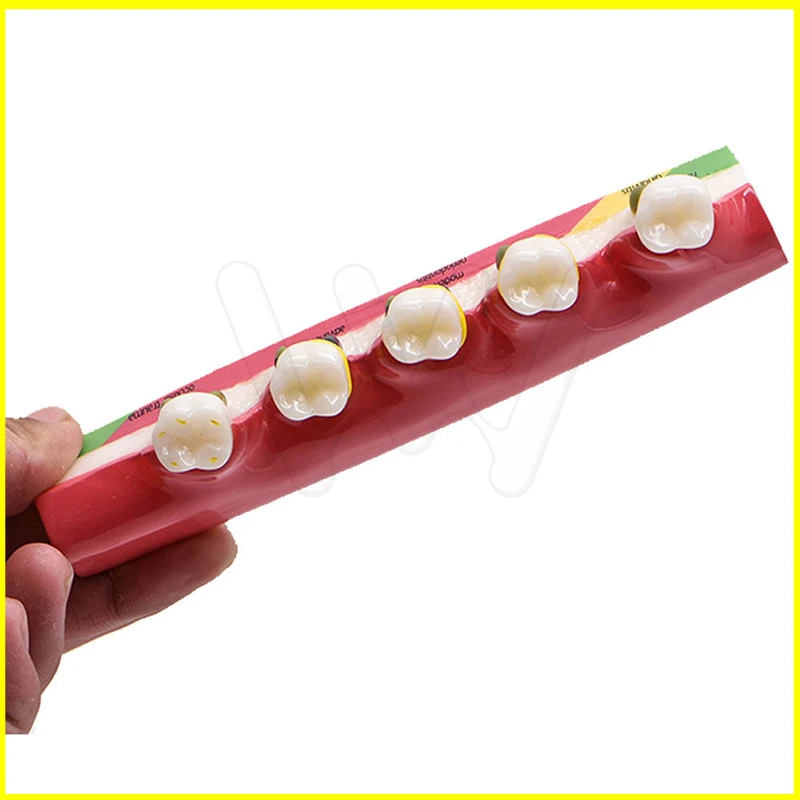 Dental-Caries-Demonstration-Model-Teeth-Teaching-Patient-Disease-_57 (4)