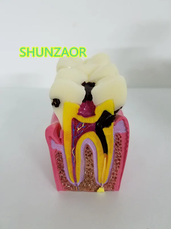 SHUNZAOR High Quality Denture Teeth model 6X, caries comparison model, tooth decay model,Dentist for Medical Science Teaching
SHUNZAOR High Quality Denture Teeth model 6X, caries comparison model, tooth decay model,Dentist for Medical Science Teaching