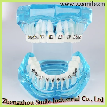 Dental Orthodontics Teeth Model With Metal Bracket/Blue Pink White 3 colors Dental Teeth Model With 20pcs Metal Brackets
Dental Orthodontics Teeth Model With Metal Bracket/Blue Pink White 3 colors Dental Teeth Model With 20pcs Metal Brackets