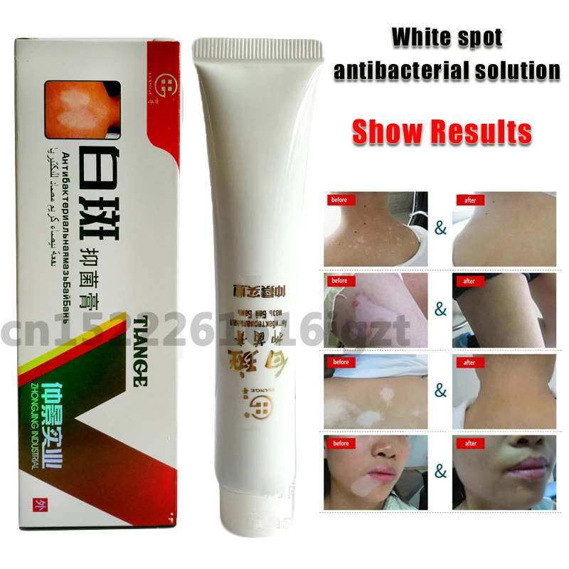 Chinese Medical White Spot Disease Cream Pigment Melanin Promoting Liniment Skin Vitiligo Leukoplakia Disease Treatment 30g
Chinese Medical White Spot Disease Cream Pigment Melanin Promoting Liniment Skin Vitiligo Leukoplakia Disease Treatment 30g