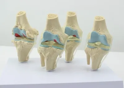 human Morbid state Knee Joint model Human Skeleton Osteoporosis model free shipping
human Morbid state Knee Joint model Human Skeleton Osteoporosis model free shipping