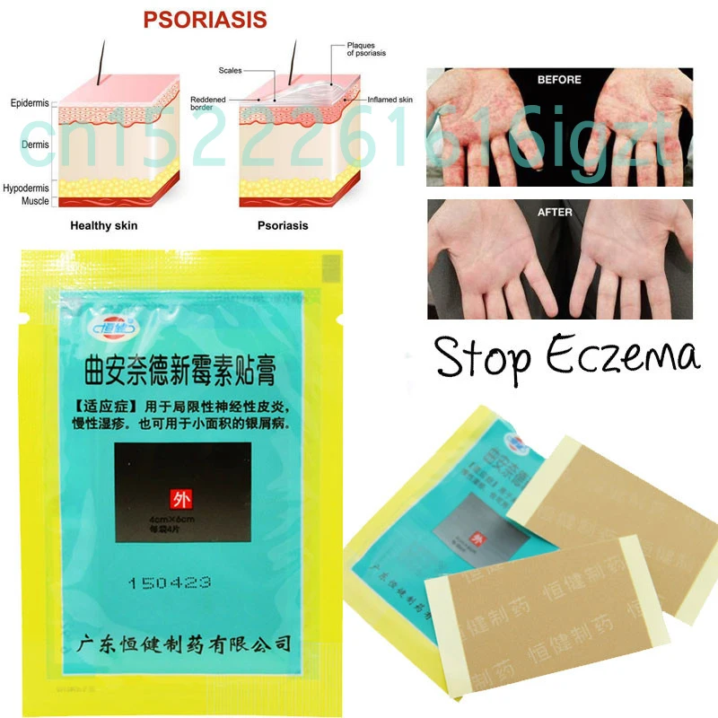 4 Patches/Bag Skin Psoriasis Plaster Dermatitis Eczematoid Eczema Plaster Treatment Psoriasis Cream Health Care
4 Patches/Bag Skin Psoriasis Plaster Dermatitis Eczematoid Eczema Plaster Treatment Psoriasis Cream Health Care
