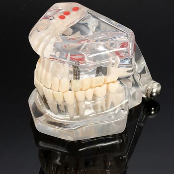 Dental Implant Disease Teeth Model With Restoration Bridge Malocclusion Orthodontic Model For Medical Science Dental Research
Dental Implant Disease Teeth Model With Restoration Bridge Malocclusion Orthodontic Model For Medical Science Dental Research
