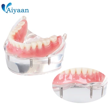 Dental Overdenture Teeth Model Removable Interior Mandibular Lower Teeth Model Mandibular with Implant for Tooth Teaching Study
Dental Overdenture Teeth Model Removable Interior Mandibular Lower Teeth Model Mandibular with Implant for Tooth Teaching Study
