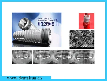 Dental Surgical Titanium Implants/DIO Dental Implants
Dental Surgical Titanium Implants/DIO Dental Implants