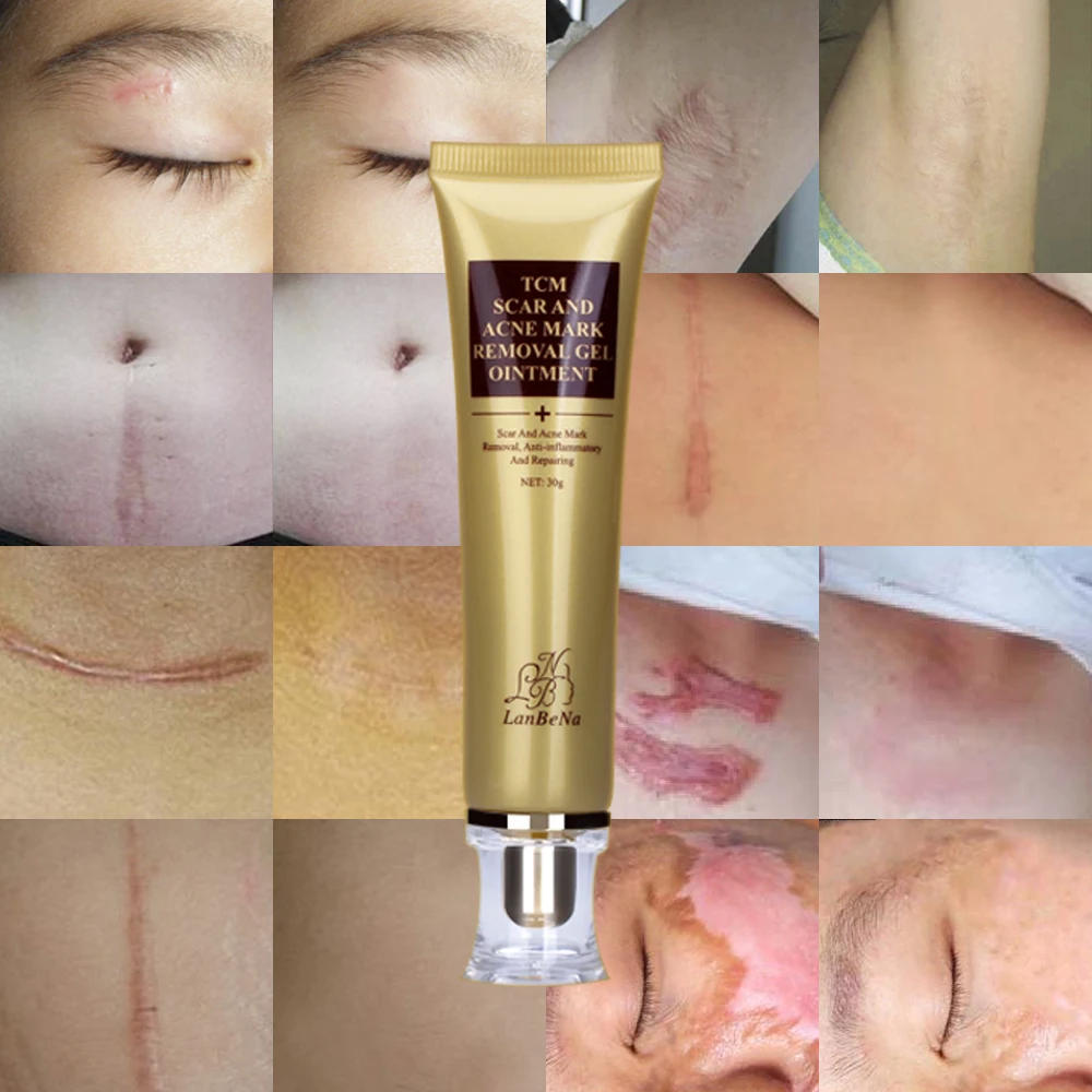 LANBENA Ginseng Acne Scar Removal Strentch Marks Acne Treatment Shrink Pores Gel Essence Whitening Face Cream Skin Care TSLM1
LANBENA Ginseng Acne Scar Removal Strentch Marks Acne Treatment Shrink Pores Gel Essence Whitening Face Cream Skin Care TSLM1