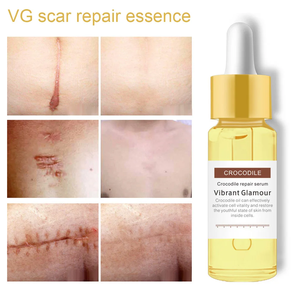 15ml Repair Scar Face Essence 2019 New Effective Acne Scar Removal Whitening Moisturizing Skin Care Pigmentation Corrector
15ml Repair Scar Face Essence 2019 New Effective Acne Scar Removal Whitening Moisturizing Skin Care Pigmentation Corrector