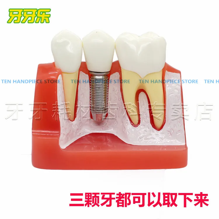 2018 good quality dental teeth model Fourfold planting model Planting hospital communication Dental teaching model
2018 good quality dental teeth model Fourfold planting model Planting hospital communication Dental teaching model