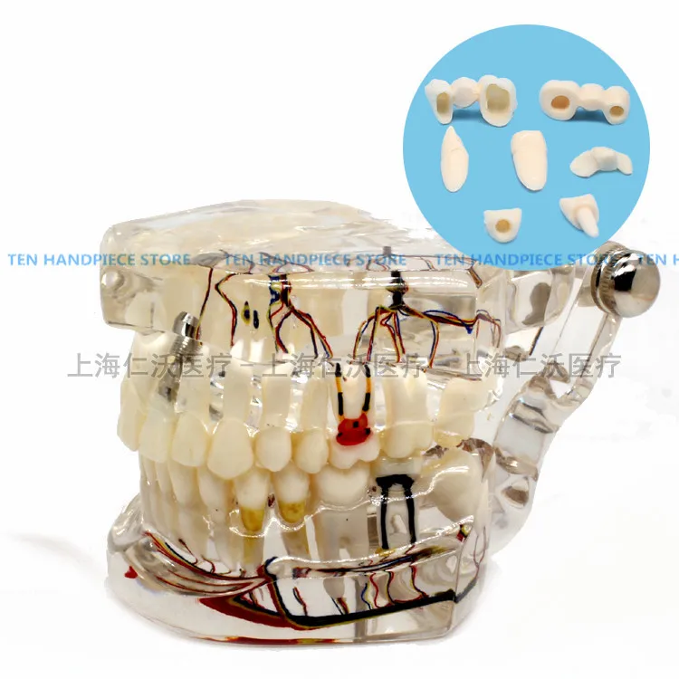 2018 good quality dental teeth model Transparent pathological implant nerve model Teaching demonstration model
2018 good quality dental teeth model Transparent pathological implant nerve model Teaching demonstration model