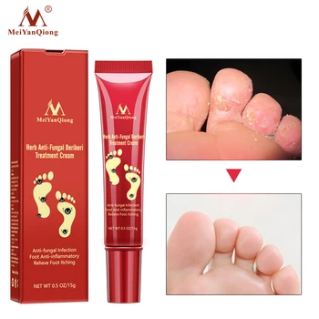 15g Hot sale Foot Care Anti Fungal Infection Feet Repair Herbal Relieve Beriberi Treatment Cream
15g Hot sale Foot Care Anti Fungal Infection Feet Repair Herbal Relieve Beriberi Treatment Cream