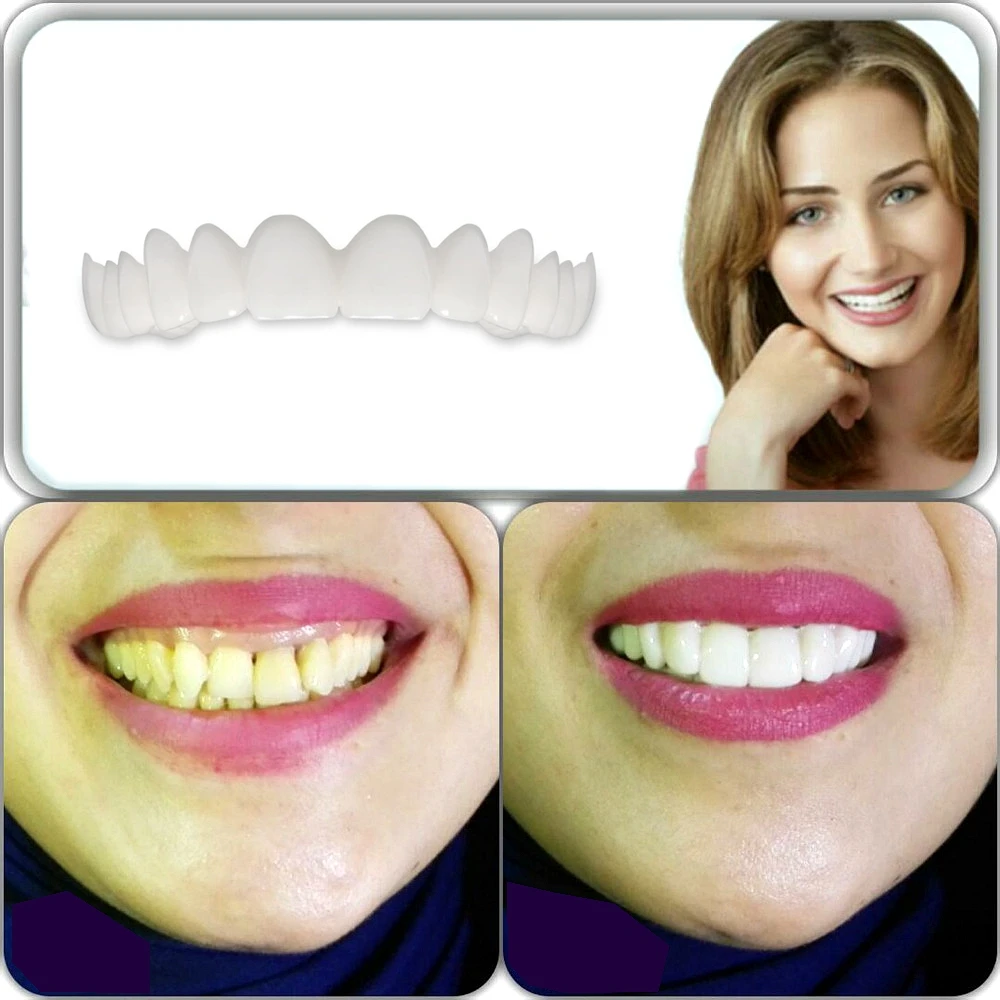 Виниры-элайнеры Snap-on smile