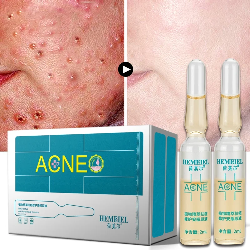 New Anti-Acne Face Serum Natural Plant Essence Scar Removal Skin Care Cream Whitening Repair Pimple Remover Acne Treatment
New Anti-Acne Face Serum Natural Plant Essence Scar Removal Skin Care Cream Whitening Repair Pimple Remover Acne Treatment