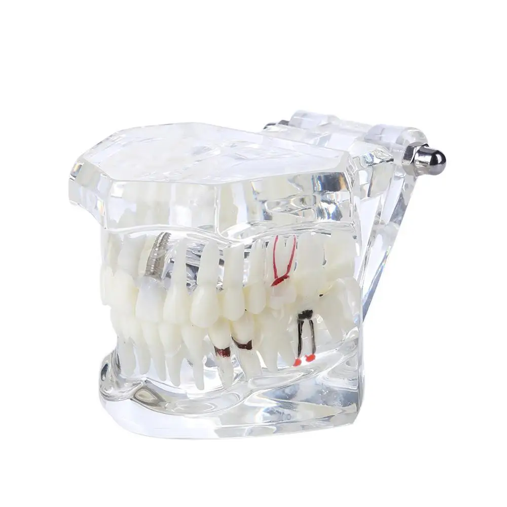 Hot Dental Implant Disease Teeth Model With Restoration Bridge Tooth Dentist For Medical Science Dental Disease Teaching Study
Hot Dental Implant Disease Teeth Model With Restoration Bridge Tooth Dentist For Medical Science Dental Disease Teaching Study