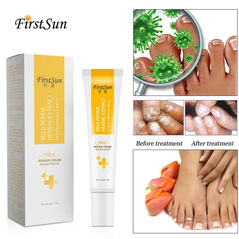 The Herb Nail Repair Cream Anti Fungal Nail Treatment Infection Essence Feet Toe Nail Fungus Treatment Onychomycosis Paronychia
The Herb Nail Repair Cream Anti Fungal Nail Treatment Infection Essence Feet Toe Nail Fungus Treatment Onychomycosis Paronychia
