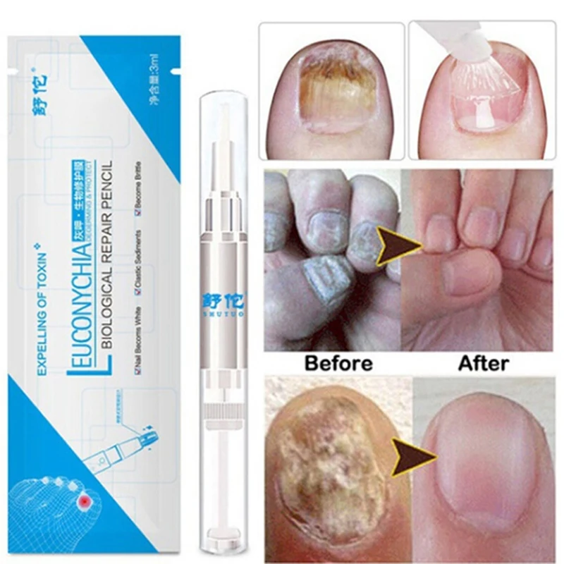 Fungal Nail Treatment Feet Care Essence Nail Foot Whitening Toe Nail Fungus Removal Gel Anti Infection Paronychia 12.5cmx1cm
Fungal Nail Treatment Feet Care Essence Nail Foot Whitening Toe Nail Fungus Removal Gel Anti Infection Paronychia 12.5cmx1cm