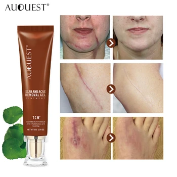 AuQuest TCM Remove Scar Acne Gel Herbal Maternity Pregnancy Body Scratches Cream Remover Beauty Skin Care Treatment Natural
AuQuest TCM Remove Scar Acne Gel Herbal Maternity Pregnancy Body Scratches Cream Remover Beauty Skin Care Treatment Natural