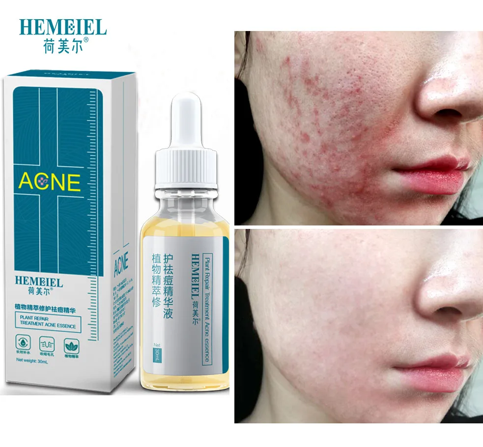 HEMEIEL Anti-Acne Face Serum Redness Repair Skin Care Oil Control Acne Treatment Skin Care Moisturizing Whitening Essence Serum
HEMEIEL Anti-Acne Face Serum Redness Repair Skin Care Oil Control Acne Treatment Skin Care Moisturizing Whitening Essence Serum