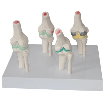 deflate Version knee model 4 stage different symptoms Knee joint lesion model
deflate Version knee model 4 stage different symptoms Knee joint lesion model