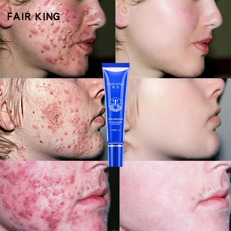 FAIR KING Acne Treatment Blackhead Removal Anti Acne Face Cream Oil Control Shrink Pores Acne Scar Remove Face Care Whitening
FAIR KING Acne Treatment Blackhead Removal Anti Acne Face Cream Oil Control Shrink Pores Acne Scar Remove Face Care Whitening