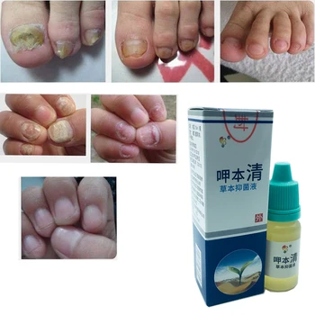 5PCS Chinese Medicine Herbs Toe Nail Fungus Treatment Anti Fungal Nail Infection Essence Nail Removal Nail Care Lotion Plaster
5PCS Chinese Medicine Herbs Toe Nail Fungus Treatment Anti Fungal Nail Infection Essence Nail Removal Nail Care Lotion Plaster