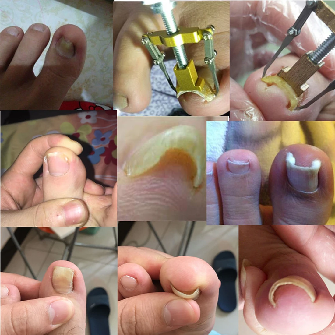 Paronychia Treatment 1PC Ingrown Toe Correction Nail Recover Clipper Tool Pedicure Toenail Fixer Lifter Foot Brace Nail Care
Paronychia Treatment 1PC Ingrown Toe Correction Nail Recover Clipper Tool Pedicure Toenail Fixer Lifter Foot Brace Nail Care