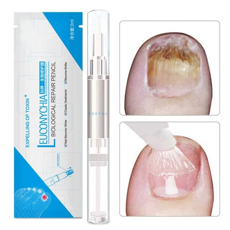 Anti Fungal Treatment Nail Pen Onychomycosis Paronychia Infection Herbal Toe Finger Nails Health Nail Fungus Nail Repair Pencil
Anti Fungal Treatment Nail Pen Onychomycosis Paronychia Infection Herbal Toe Finger Nails Health Nail Fungus Nail Repair Pencil