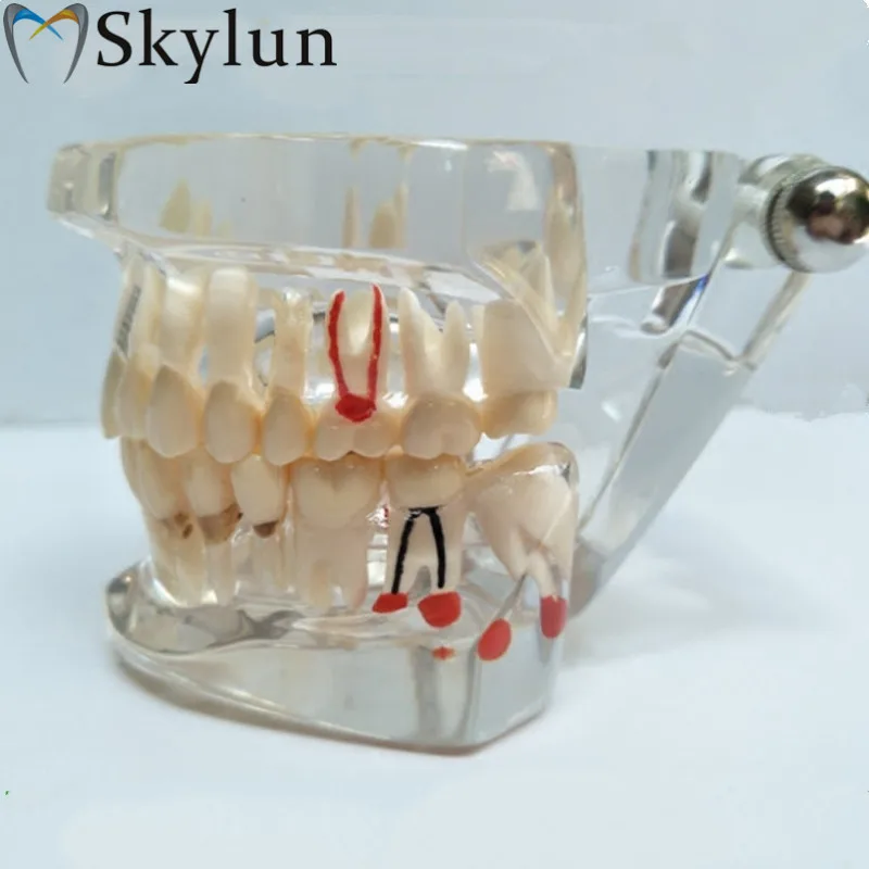 Dental tooth model active tooth pathology model detachable 11 teeth model dental material SL722
Dental tooth model active tooth pathology model detachable 11 teeth model dental material SL722