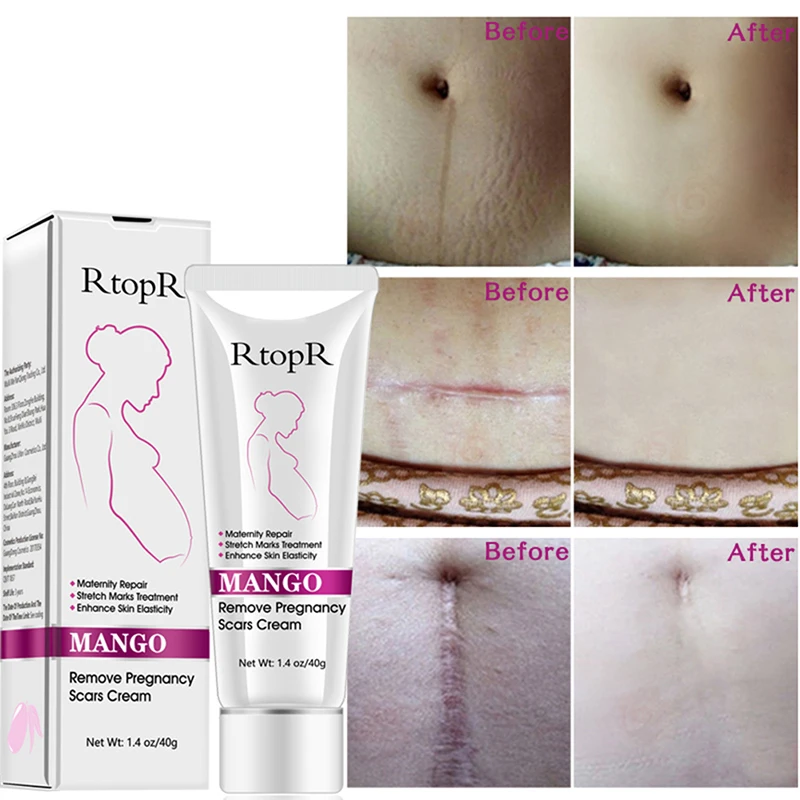 Anti-Aging Anti Winkles Firming Body Creams Mango Remove Pregnancy Scars Acne Cream Stretch Marks Treatment Maternity Repair
Anti-Aging Anti Winkles Firming Body Creams Mango Remove Pregnancy Scars Acne Cream Stretch Marks Treatment Maternity Repair