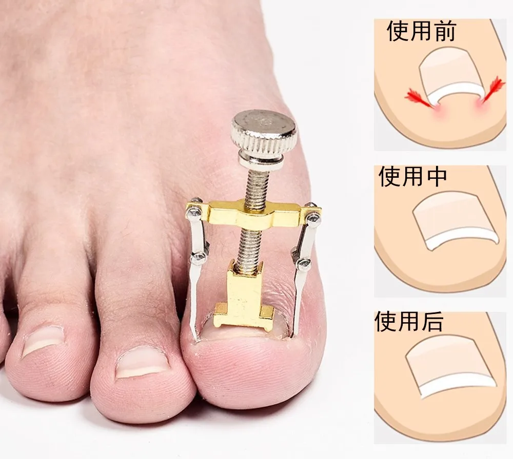 1pc Useful Ingrown Nail Foot Correction Tool Pedicure Toenail Fixer Foot Nail Care Tool Orthotic Nail Corrector Pedicure LJ20
1pc Useful Ingrown Nail Foot Correction Tool Pedicure Toenail Fixer Foot Nail Care Tool Orthotic Nail Corrector Pedicure LJ20