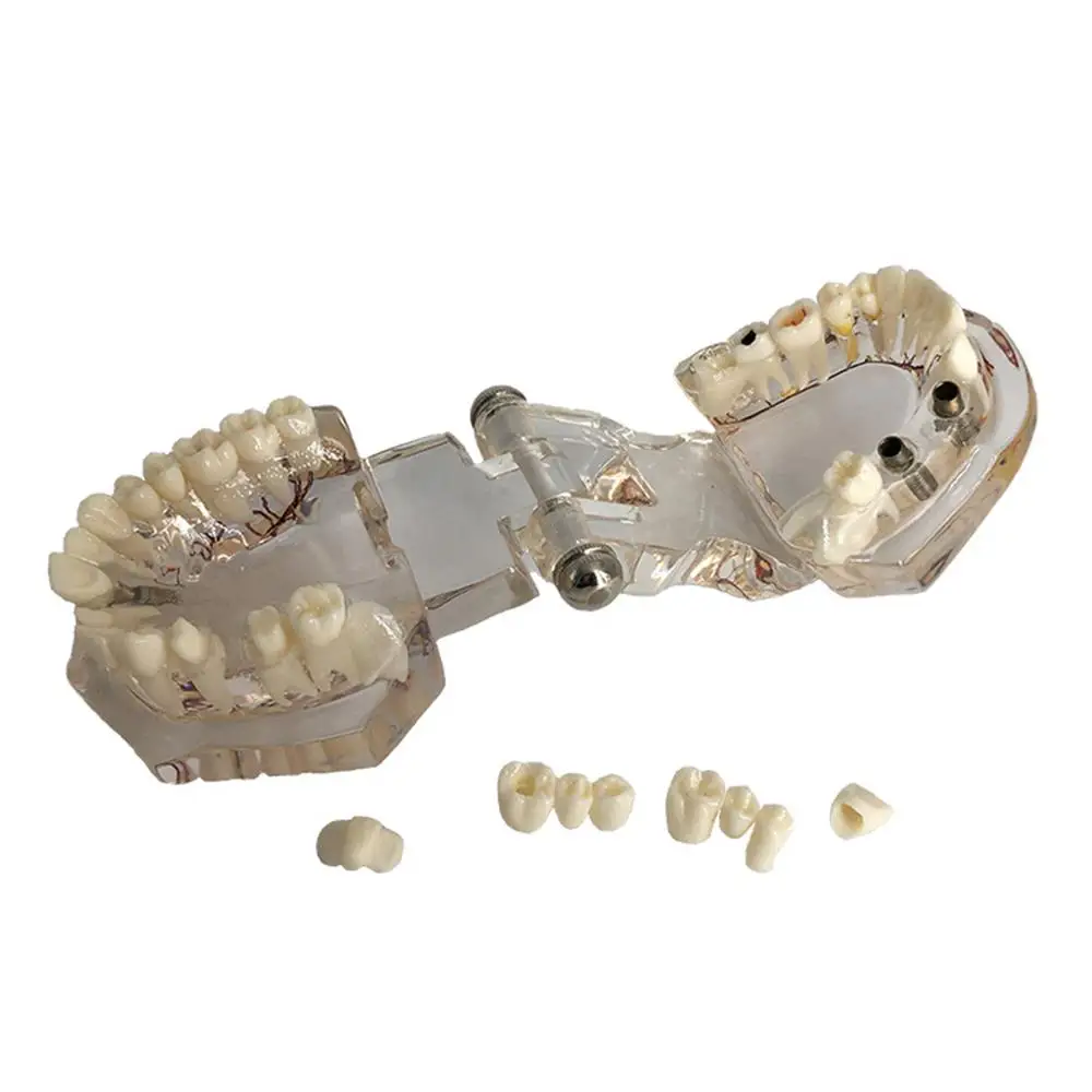 Dental Disease Implant Teeth Model with Restoration Bridge Tooth Dentist for Medical Science Disease Teaching Study
Dental Disease Implant Teeth Model with Restoration Bridge Tooth Dentist for Medical Science Disease Teaching Study