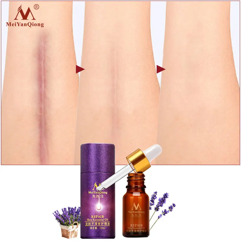 2PCS Scar Repair Essential Oil Lavender Essence Skin Care Natural Pure Remove Ance Burn Strentch Marks Scar Removal Treatment
2PCS Scar Repair Essential Oil Lavender Essence Skin Care Natural Pure Remove Ance Burn Strentch Marks Scar Removal Treatment