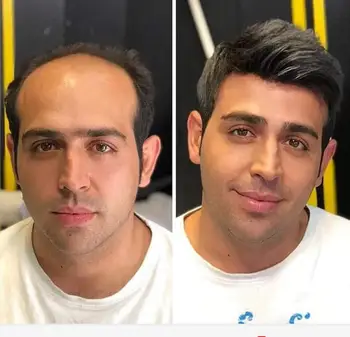 Lace Front Human Hair Toupee Replacement Dark Brown Mono Toupee for Men 100% Human Hair System
Lace Front Human Hair Toupee Replacement Dark Brown Mono Toupee for Men 100% Human Hair System
