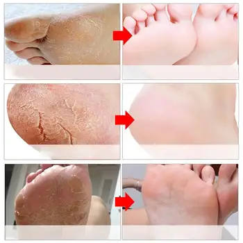 4 Pcs Feet Exfoliating Mask For Family Winter Removing Dead Care Enhancing Mask Smooth Soft Skin Moisturizing Foot Z6F2
4 Pcs Feet Exfoliating Mask For Family Winter Removing Dead Care Enhancing Mask Smooth Soft Skin Moisturizing Foot Z6F2