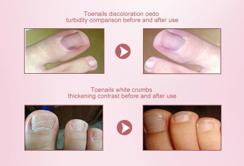 OEDO Healthy Nail Care Herbal Fungus Nail Repair Essential Oil Hand and Foot Bright White Toe Nail Remove Fungus Infected Nail OEDO Healthy Nail Care Herbal Fungus Nail Repair Essential Oil Hand and Foot Bright White Toe Nail Remove Fungus Infected Nail
