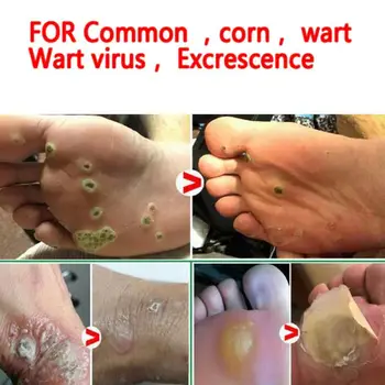 Feet Corn Remover Powerful Foot Fingers Callus Remover Smooth Care Safe Skin Warts Skin Treatment Rejuvenation Liquid Body O7J0
Feet Corn Remover Powerful Foot Fingers Callus Remover Smooth Care Safe Skin Warts Skin Treatment Rejuvenation Liquid Body O7J0