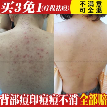 Back Care Essential Oil Acne Scar Spots Removal Skin Care Whitening Remove Scars Acne Repair Face Cream Essence Acne Treatment
Back Care Essential Oil Acne Scar Spots Removal Skin Care Whitening Remove Scars Acne Repair Face Cream Essence Acne Treatment