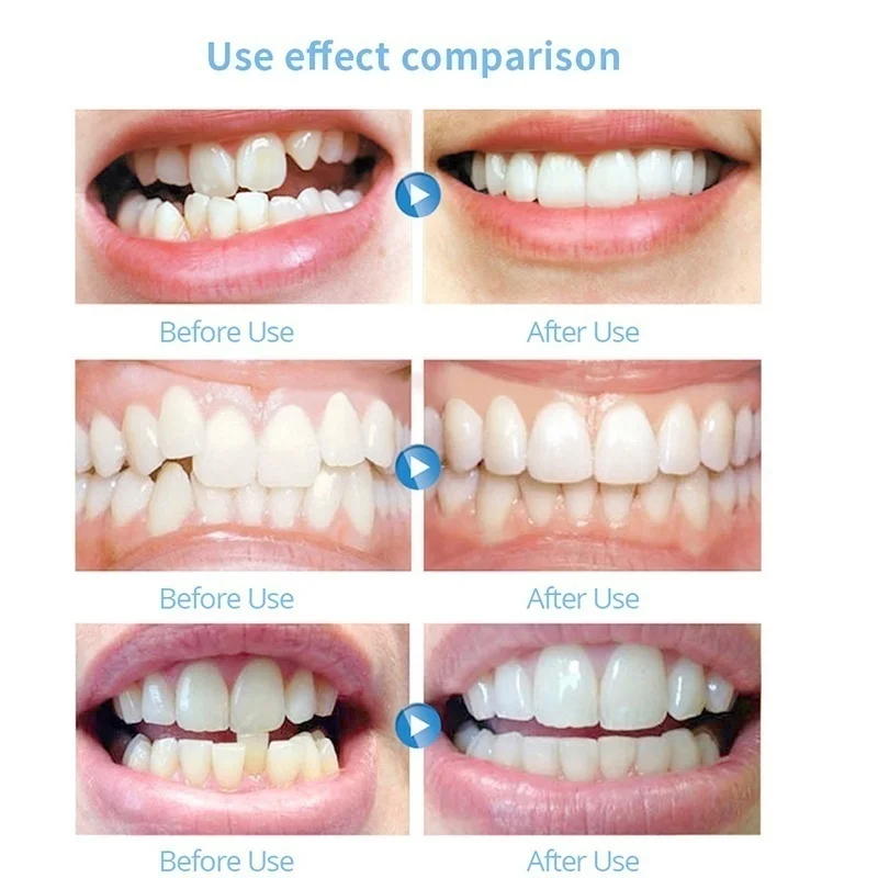 Shop Generic Invisible Dental Orthodontic Braces Adult Tooth Alignment