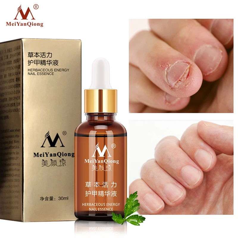 Nail Fungal Treatment Feet Care Essence Nail Foot Whitening Toe Nail Fungus Removal Gel Anti Infection Paronychia Onychomycosis
Nail Fungal Treatment Feet Care Essence Nail Foot Whitening Toe Nail Fungus Removal Gel Anti Infection Paronychia Onychomycosis
