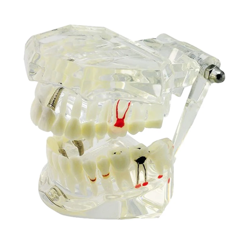 Removable Prosthetic Demonstrative Implant Disease Teeth Model Dental Oral Care Tool Hot Dental Implant Disease Teeth Model
Removable Prosthetic Demonstrative Implant Disease Teeth Model Dental Oral Care Tool Hot Dental Implant Disease Teeth Model