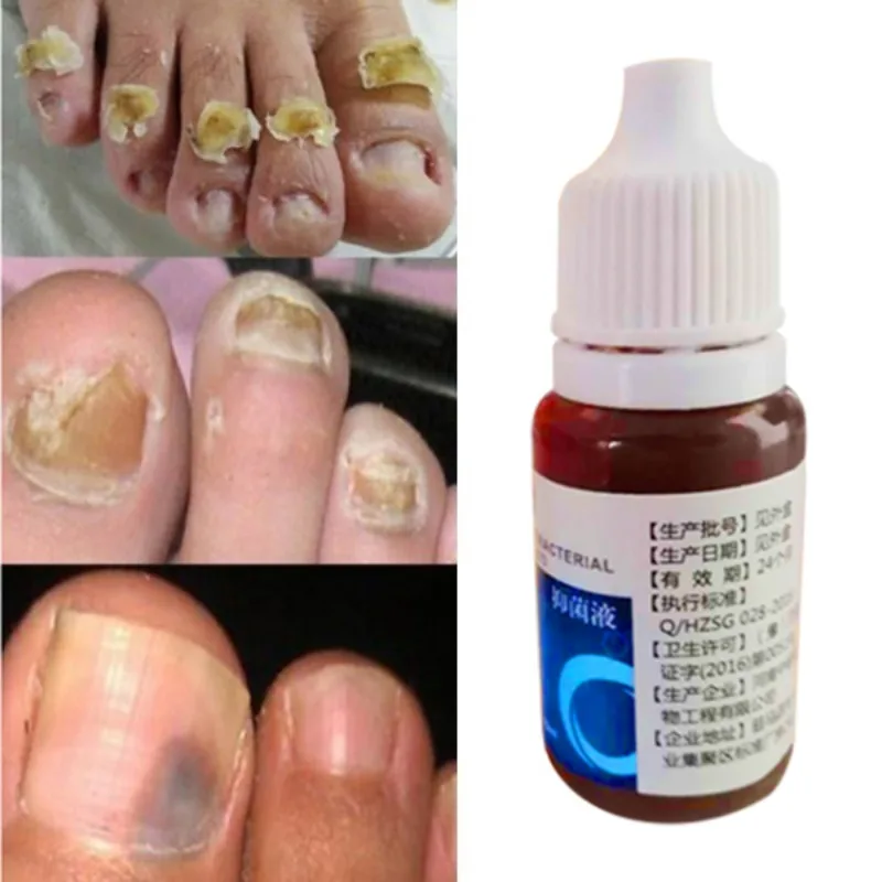 2019 Nail Repair Fungus Removal Gel Anti Infection Paronychia Onychomycosis Fungal Nail Treatment Feet Care Oil
2019 Nail Repair Fungus Removal Gel Anti Infection Paronychia Onychomycosis Fungal Nail Treatment Feet Care Oil
