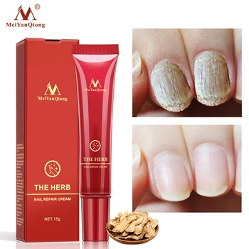 Fungal Nail Repair Serum Treatment Foot Nail Fungus Removal Essence Gel Anti Infection Paronychia Onychomycosis Nail Care 15G 
Fungal Nail Repair Serum Treatment Foot Nail Fungus Removal Essence Gel Anti Infection Paronychia Onychomycosis Nail Care 15G